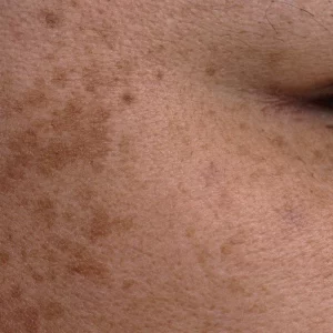 Hyperpigmentation_blog