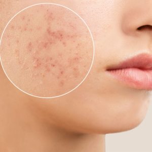 acné-hormonal-age-adulte-marinel-paris-700x467